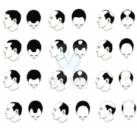 【腾博会官网基因检测】过早<font color='red'>脱发</font>、掉发太多怎么办？你的方法可能是错的！